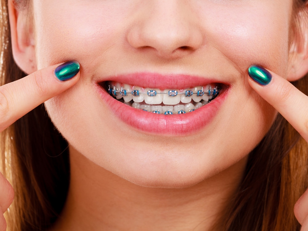 Smile Makeover with Braces